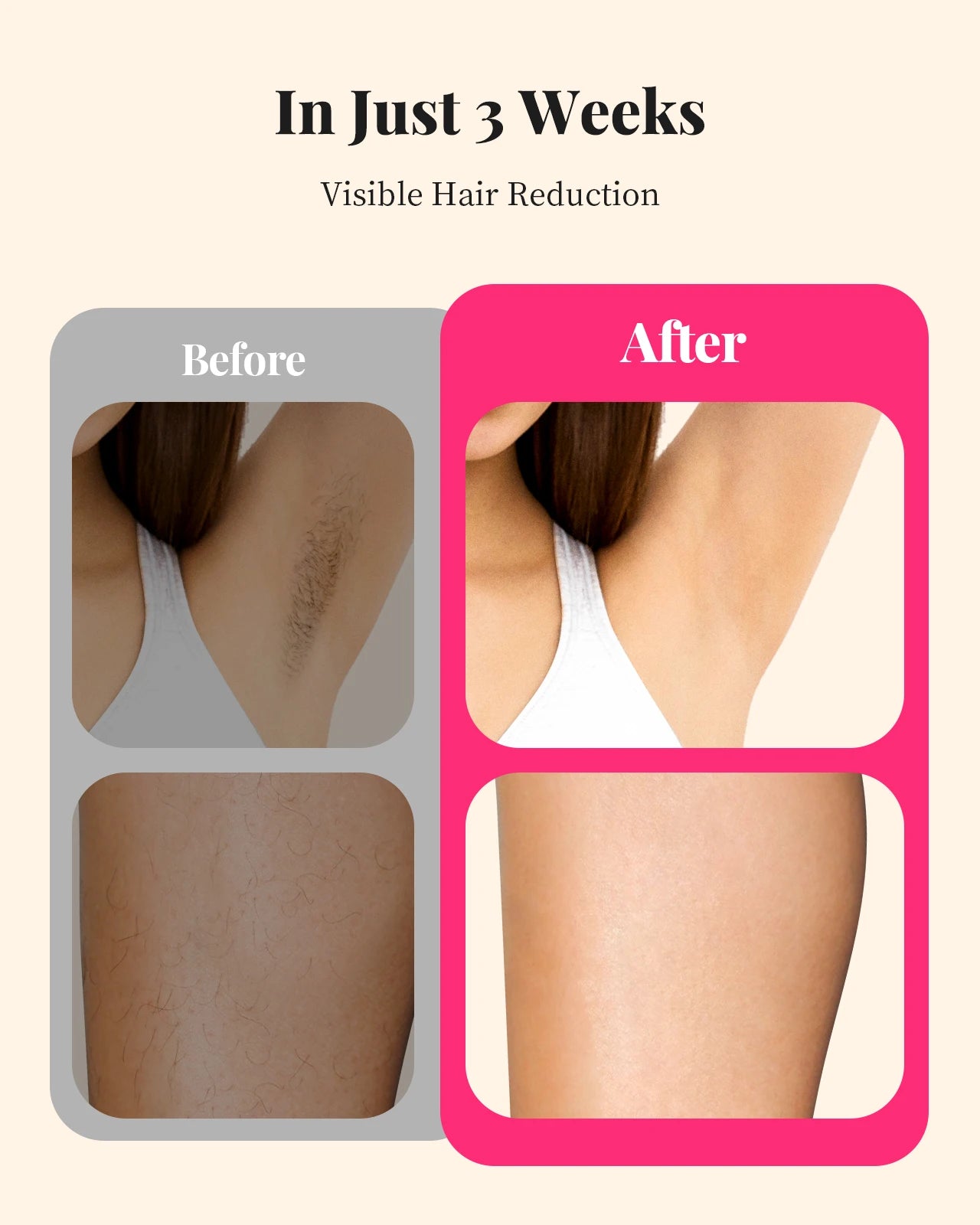Painless Permanent Laser Hair removal